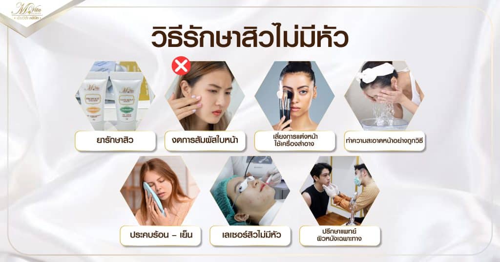 วิธีรักษาสิวไม่มีหัว