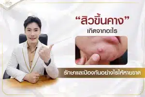 สิวขึ้นคางเกิดจากอะไร รักษาและป้องกันอย่างไรให้หายขาด