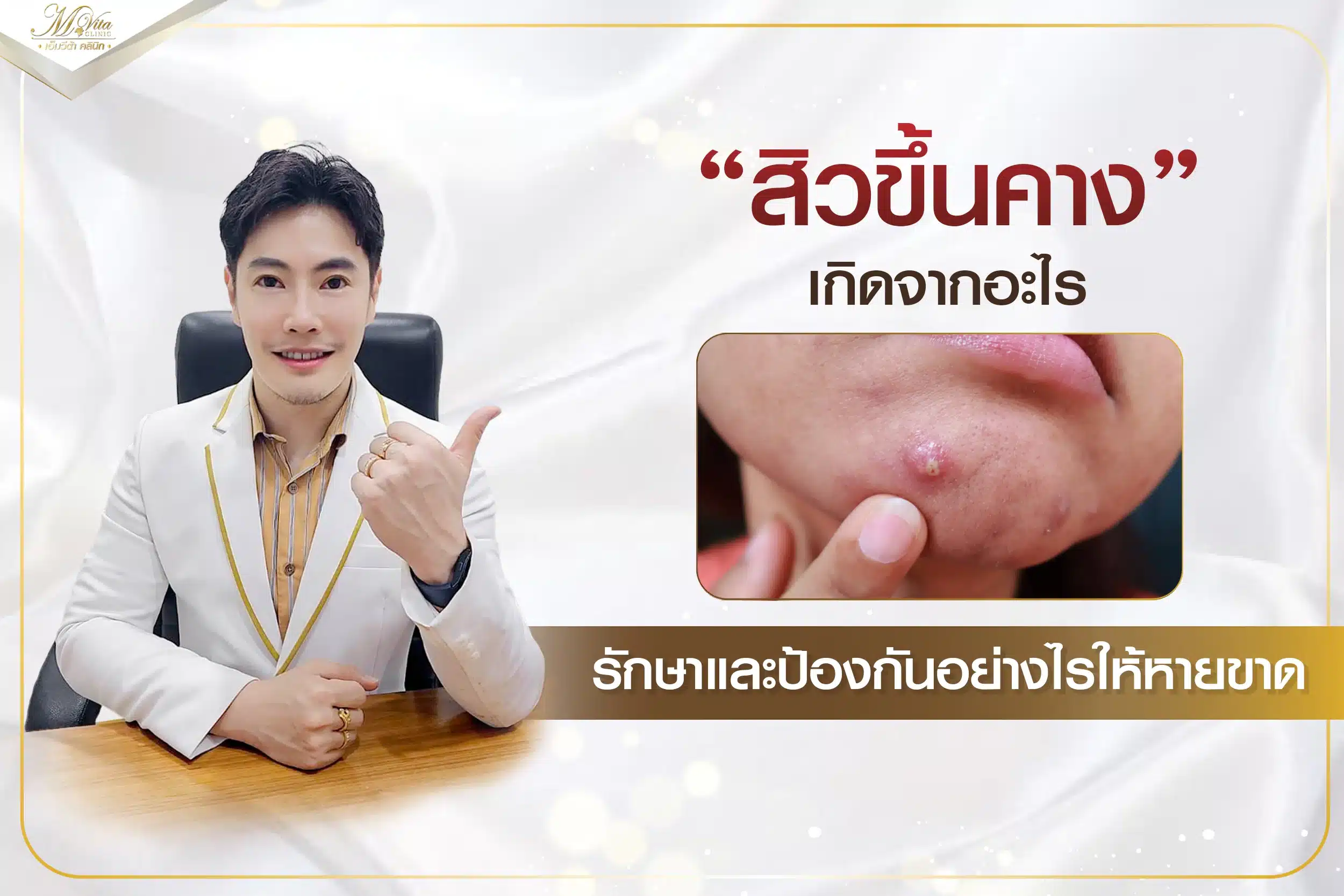 สิวขึ้นคางเกิดจากอะไร รักษาและป้องกันอย่างไรให้หายขาด