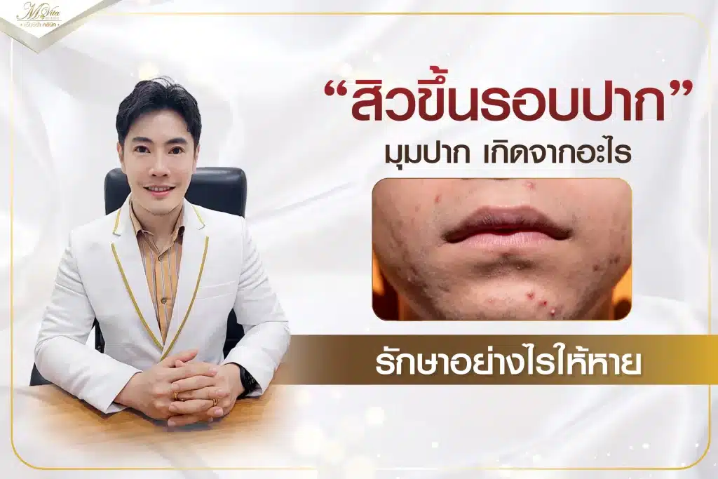 สิวขึ้นรอบปาก มุมปาก เกิดจากอะไร รักษาอย่างไรให้หาย