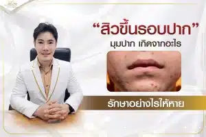 สิวขึ้นรอบปาก มุมปาก เกิดจากอะไร รักษาอย่างไรให้หาย