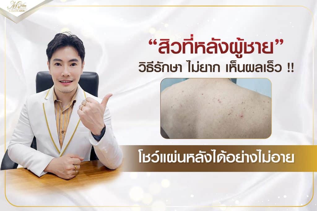 สิวที่หลังผู้ชาย-วิธีรักษา