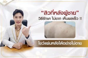 สิวที่หลังผู้ชาย-วิธีรักษา