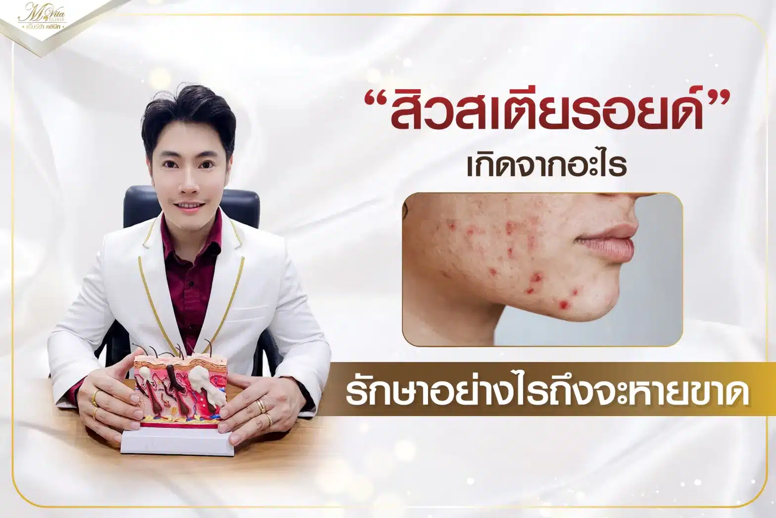 สิวสเตียรอยด์ เกิดจากอะไร รักษาอย่างไรถึงจะหายขาด