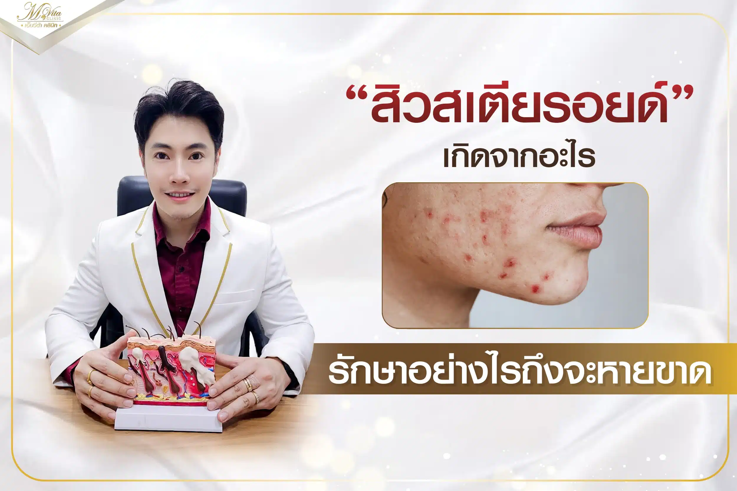 สิวสเตียรอยด์ เกิดจากอะไร รักษาอย่างไรถึงจะหายขาด
