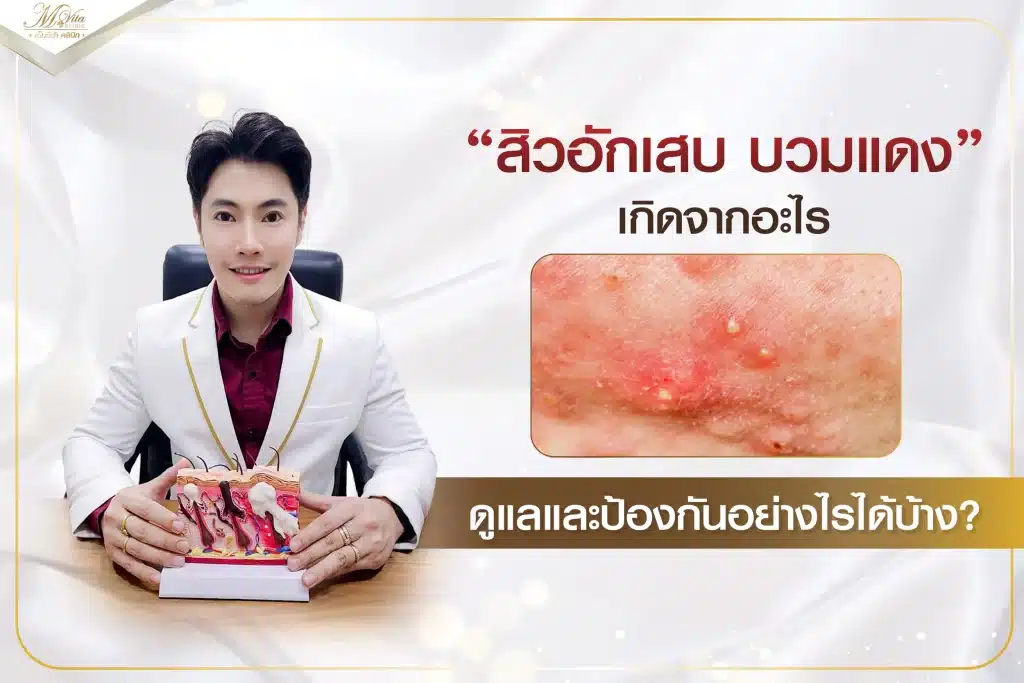 สิวอักเสบ บวมแดง เกิดจากอะไร ดูแลและป้องกันอย่างไรได้บ้าง