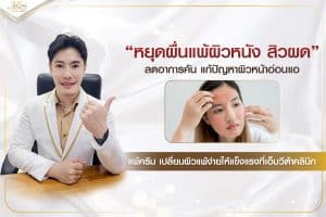 หยุดผื่นแพ้ผิวหนัง สิวผด