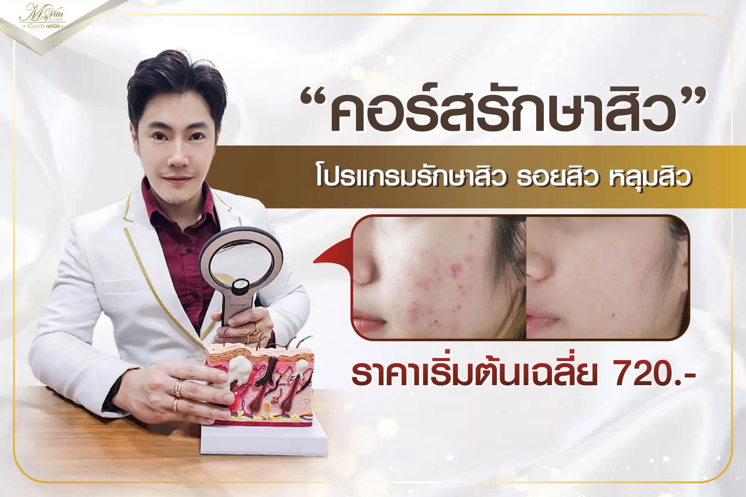 คอร์สรักษาสิว โปรแกรมรักษาสิว