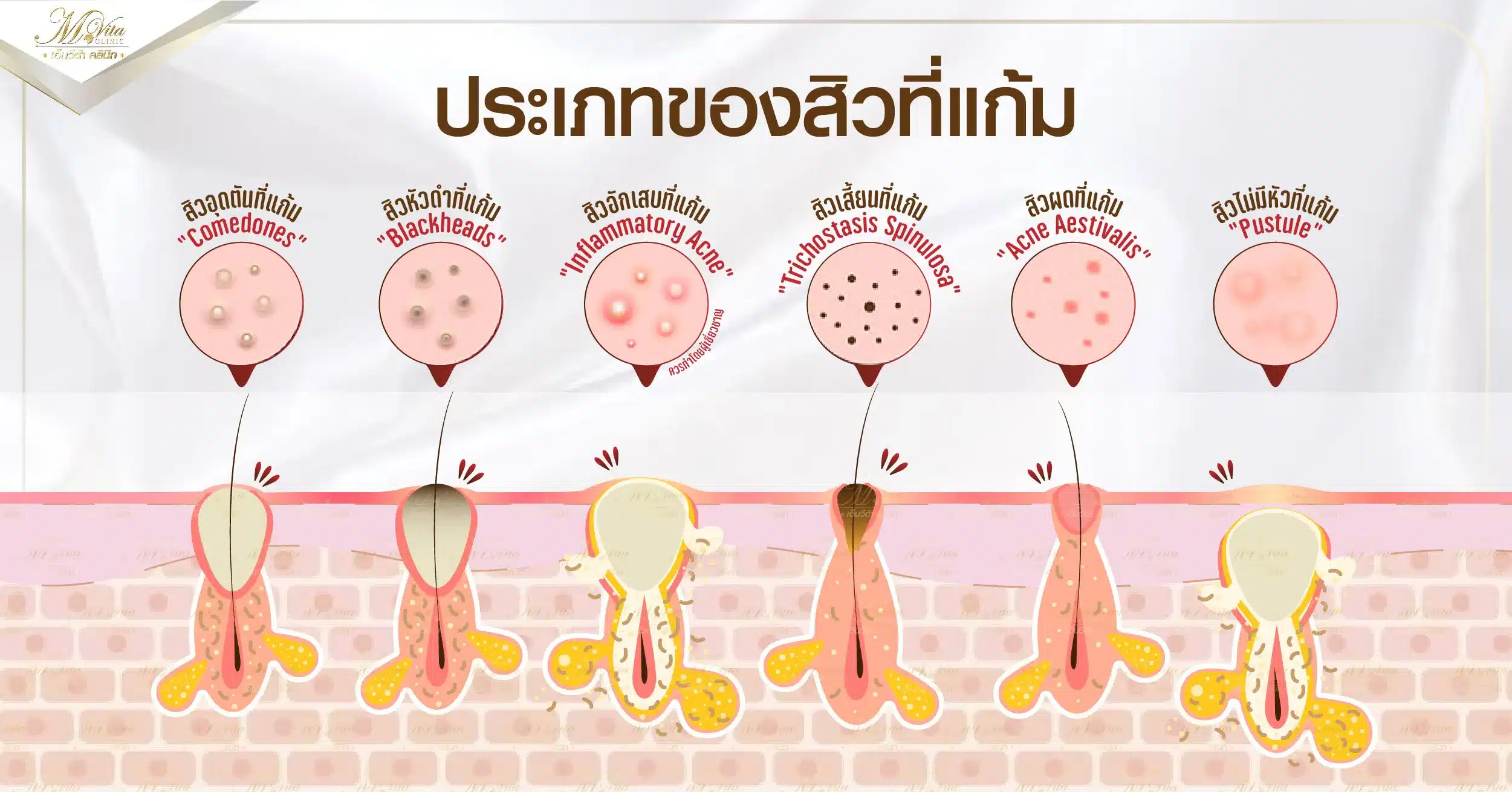 ประเภทของสิวที่แก้ม