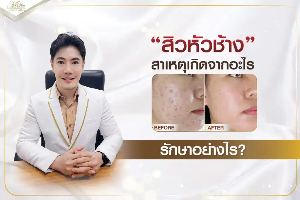 สิววหัวช้าง สาเหตุเกิดจากอะไร รักษาอย่างไร 2