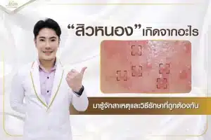 ไขข้อสงสัย สิวหัวหนองอักเสบ
