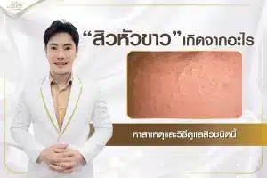 สิวหัวขาว