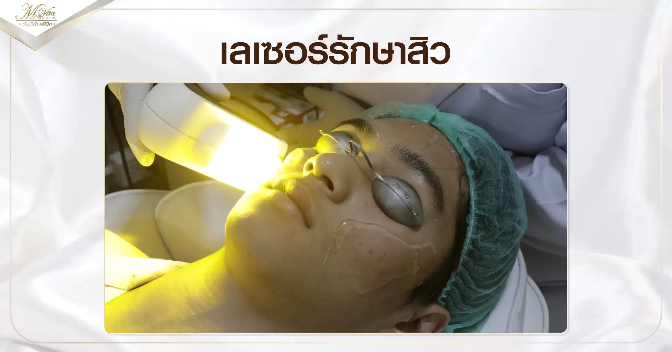เลเซอร์รักษาสิว