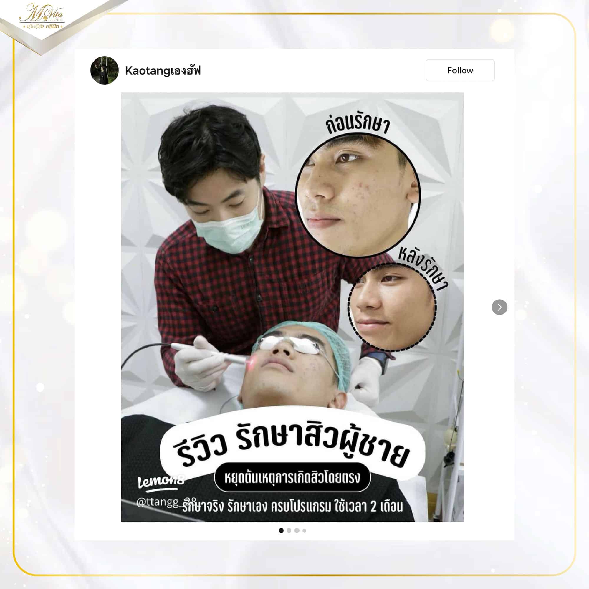 รักษาสิวผู้ชาย-01