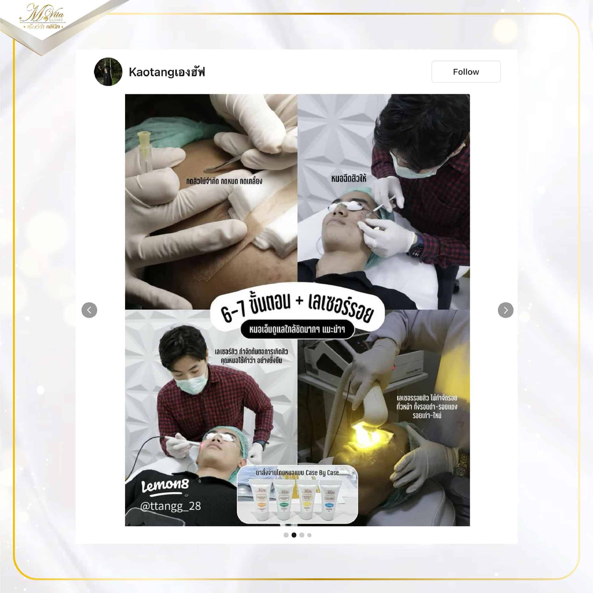 รักษาสิวผู้ชาย-02