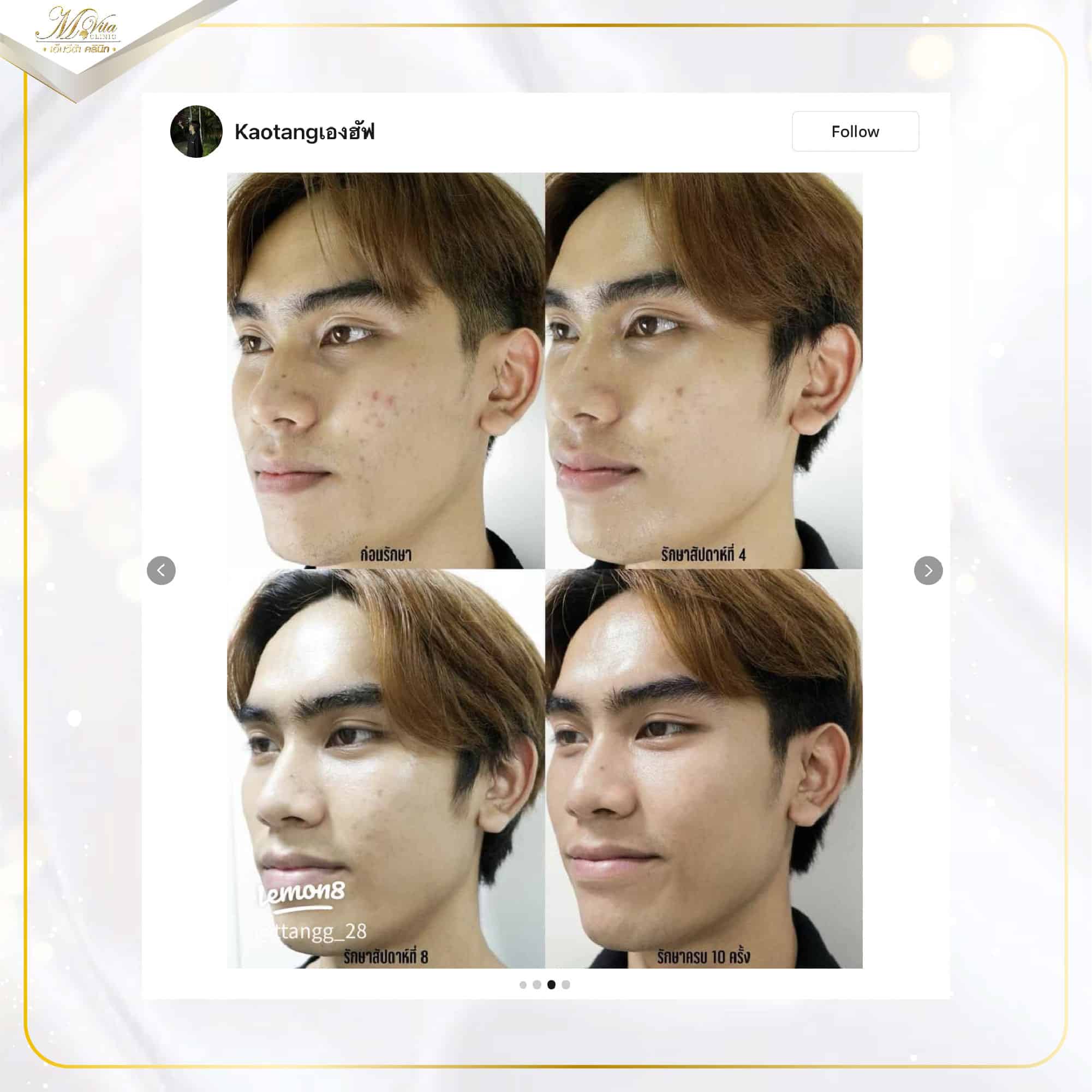 รักษาสิวผู้ชาย-03