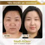 รีวิว-รักษาสิวและรอย-1-01-1