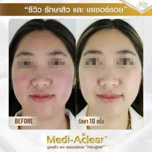รีวิว-รักษาสิวและรอย-A-01-1