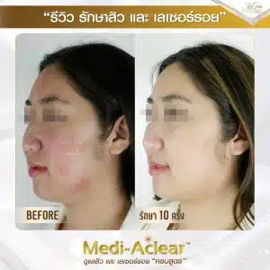 รีวิว-รักษาสิวและรอย-A2-01-1