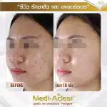 รีวิว-รักษาสิวและรอย-ครีม-1-01-1