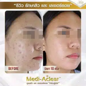 รีวิว-รักษาสิวและรอย-ครีม-2-01-1