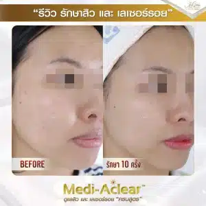 รีวิว-รักษาสิวและรอย-คุณมัช-2-01-1