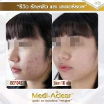 รีวิว-รักษาสิวและรอย-คุณอาย-01-1