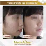 รีวิว-รักษาสิวและรอย-คุณอาย-1-01-1