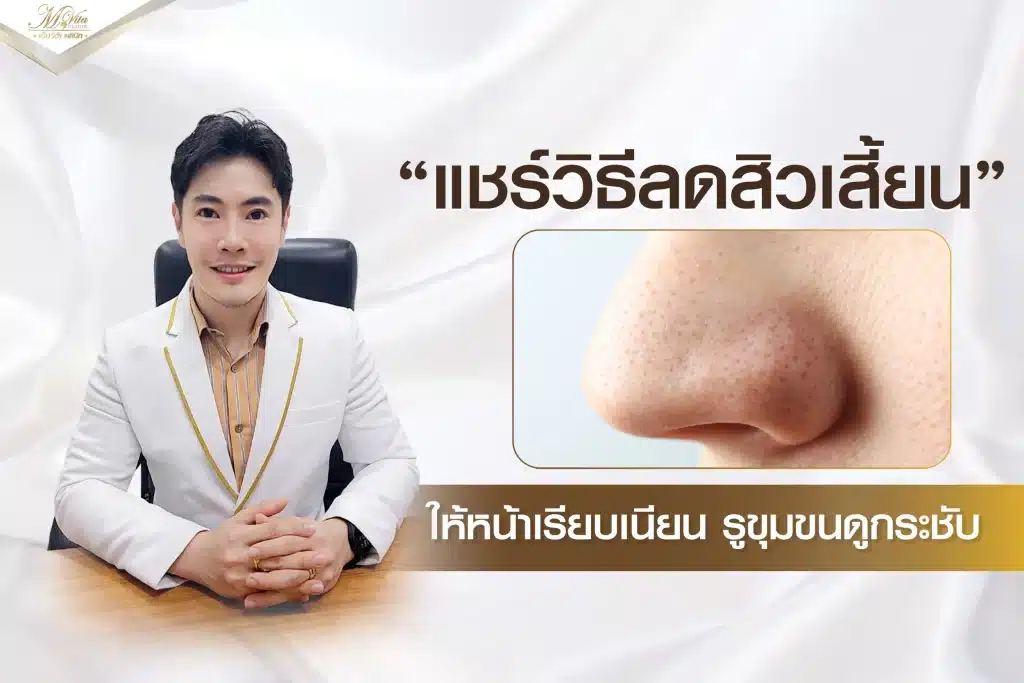 แชร์วิธีลดสิวเสี้ยน