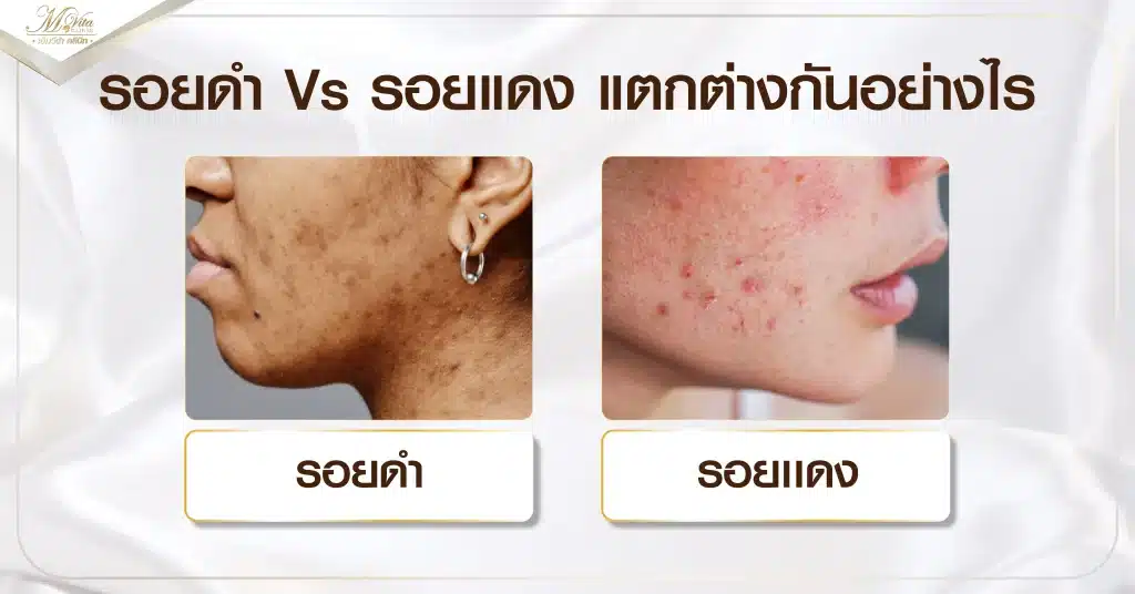 รอยดำ Vs รอยแดง แตกต่างกันอย่างไร