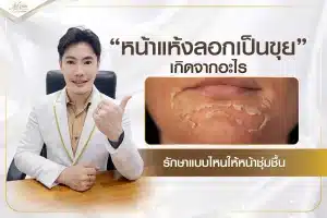 หน้าแห้งลอกเป็นขุย