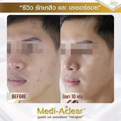 รีวิวรักษาสิว ของ เอ็มวีต้าคลินิก