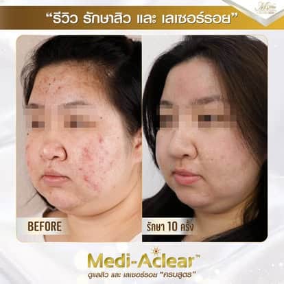 รีวิวรักษาสิว ของ เอ็มวีต้าคลินิก