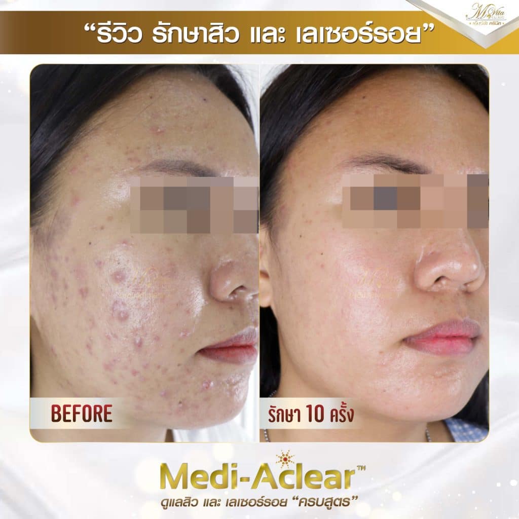 รีวิวรักษาสิว ของ เอ็มวีต้าคลินิก