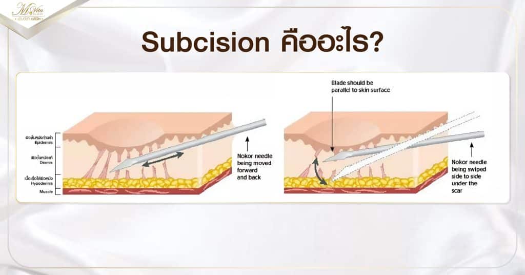 Subcision Thread Subcision คืออะไร ช่วยรักษาหลุมสิวได้หรือไม่ เหมาะกับใครบ้าง
