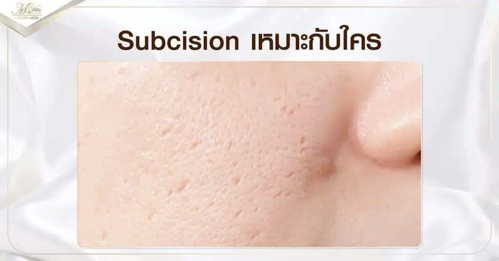 Subcision เหมาะกับใคร