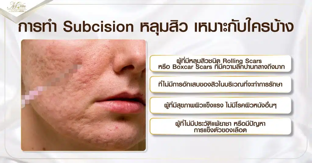 การทำ Subcision หลุมสิว เหมาะกับใครบ้าง