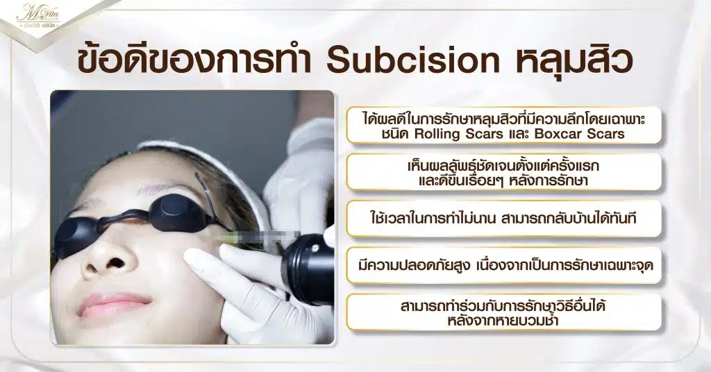 ข้อดีของการทำ Subcision หลุมสิว