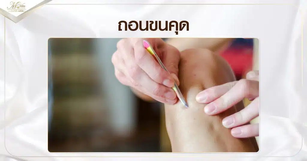 ถอนขนคุด