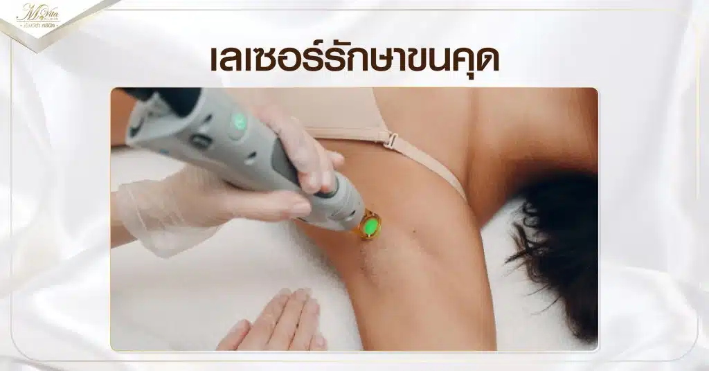 เลเซอร์รักษาขนคุด