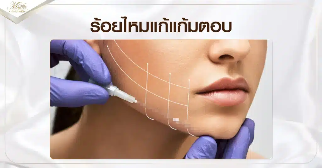 ร้อยไหมแก้แก้มตอบ