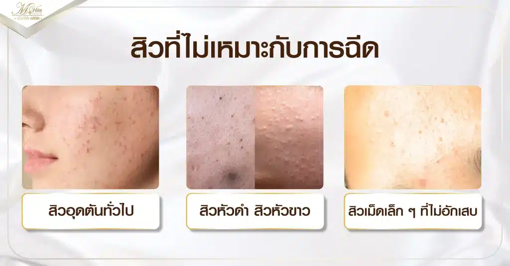 สิวที่ไม่เหมาะกับการฉีด