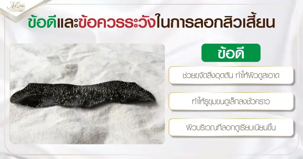 ข้อดีและข้อควรระวังในการลอกสิวเสี้ยน (ข้อดี)
