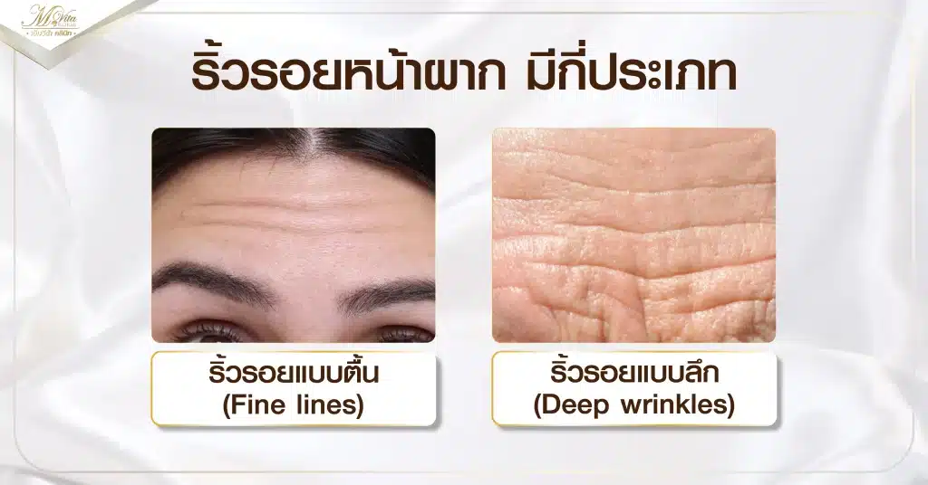 ริ้วรอยหน้าผาก มีกี่ประเภท