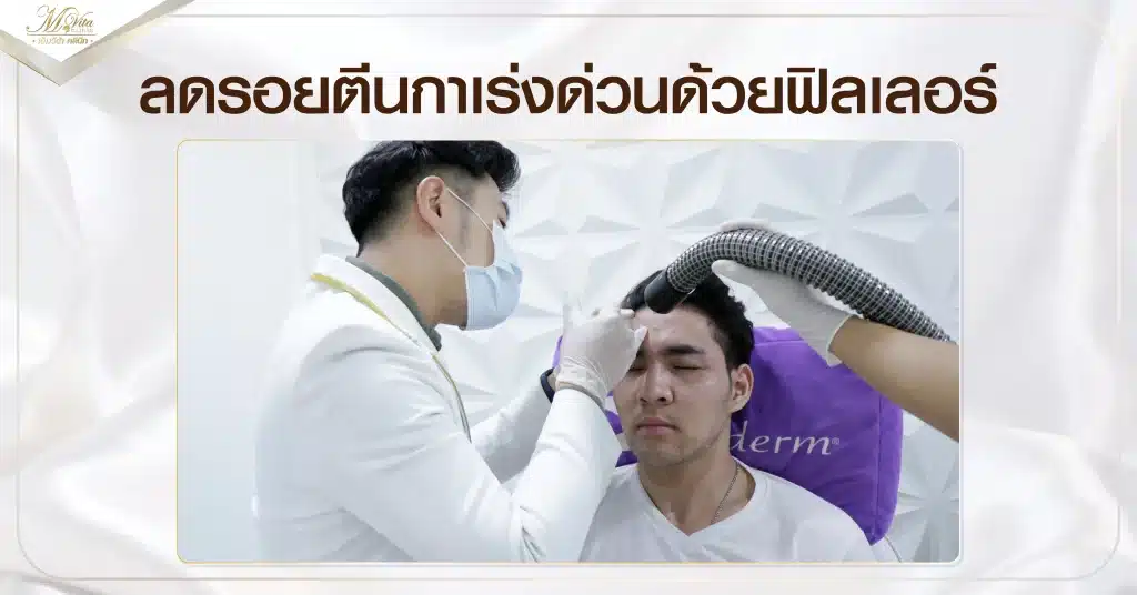 ลดรอยตีนกาเร่งด่วนด้วยฟิลเลอร์