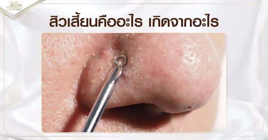สิวเสี้ยนคืออะไร เกิดจากอะไร