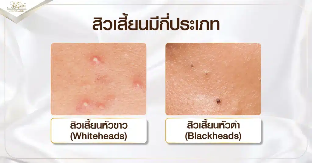 สิวเสี้ยนมีกี่ประเภท