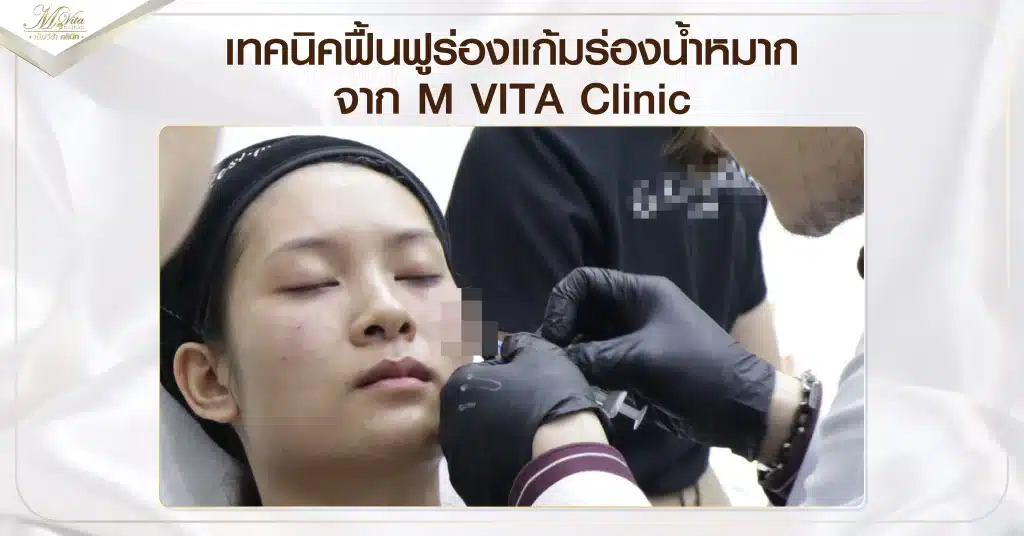 ร่องน้ําหมากสามารถฉีดโบท็อกซ์ได้หรือไม่