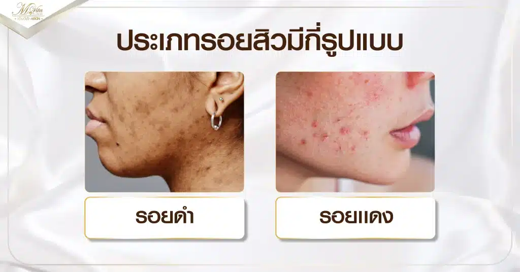 รอยสิว คืออะไร