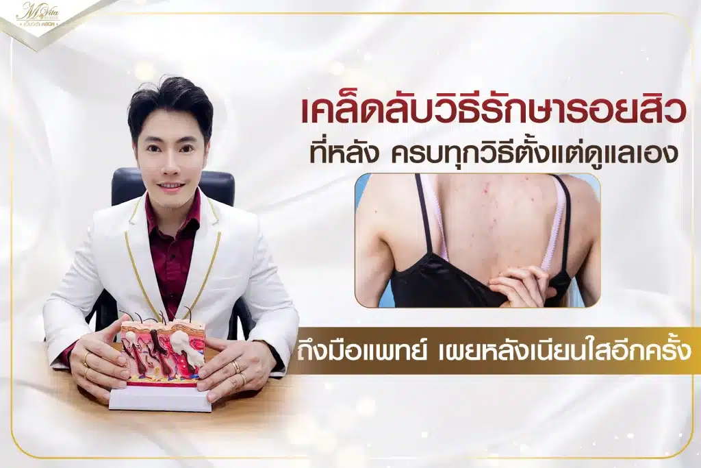 เคล็ดลับวิธีรักษารอยสิวที่หลัง